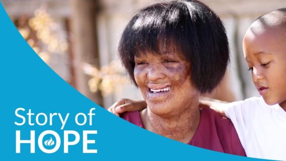 J_8y451al6c -burned Alive by Husband. Katie’s Inspirational Story of Hope and Truimph - U-witness.com by Witness