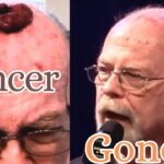 Wyxjyulzgpw -cancer Fell off His Head! Doctors Couldn’t Believe It. - U-witness.com by Witness